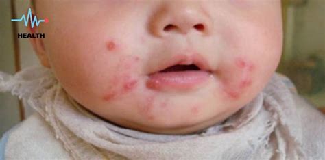 puke ng bata|Mamaso O Impetigo: Sanhi, Sintomas, Gamot Para Rito.